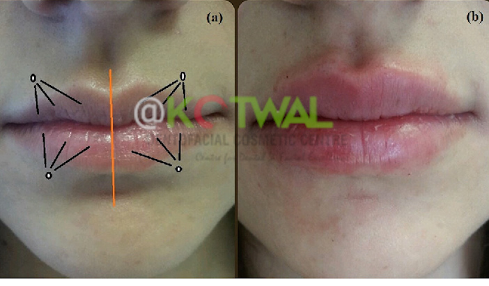 Lip Augmentation